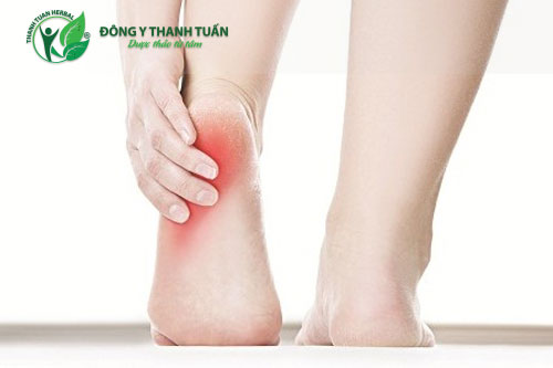 Bị đau thốn hai gót chân do bệnh gout gây ra