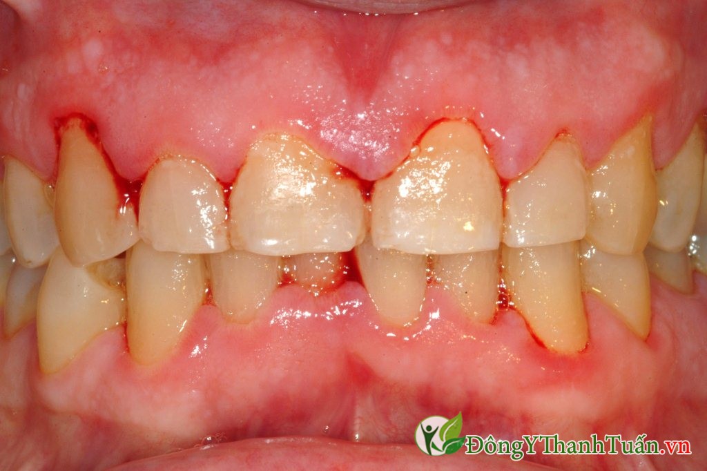 viêm lợi nguyên nhân gây chảy máu chân răng