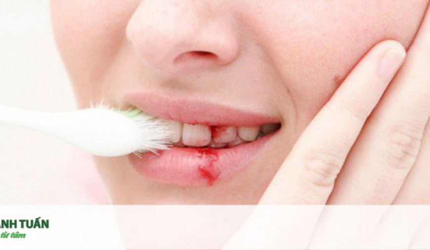 5 dấu hiệu nhận biết bệnh viêm nướu răng