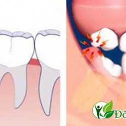 Cách chữa viêm lợi trùm trong nha khoa