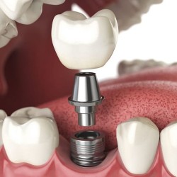 Chia sẻ từ chuyên gia: Chăm sóc răng miệng sau cấy ghép IMPLANT đúng chuẩn?