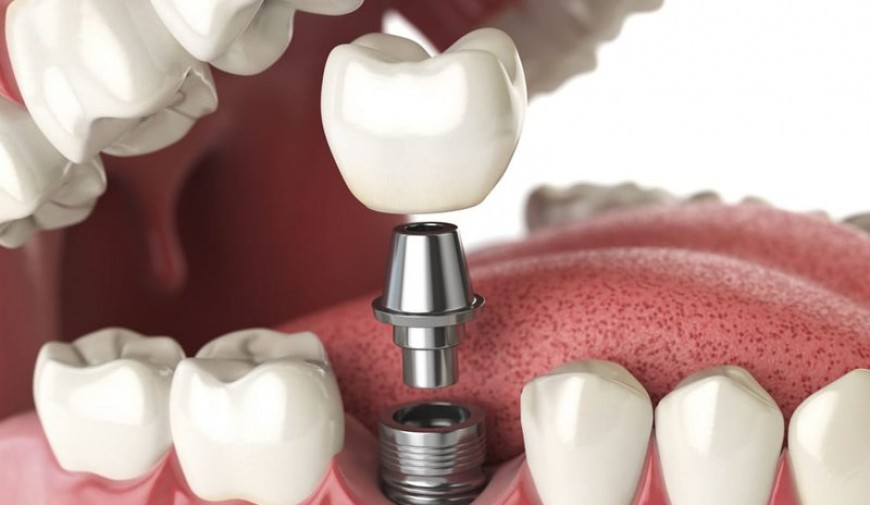 Chia sẻ từ chuyên gia: Chăm sóc răng miệng sau cấy ghép IMPLANT đúng chuẩn?