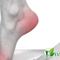 Tình trạng đau gót chân là triệu chứng của bệnh gì?