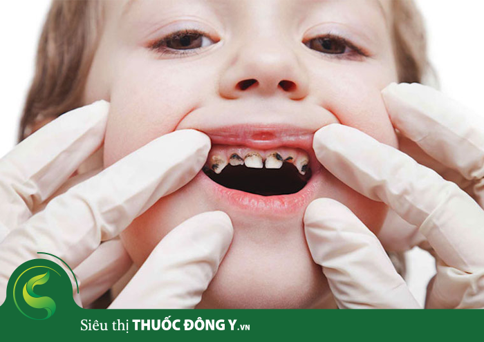 Sâu răng là một trong những nguyên nhân dẫn tới nhức răng.
