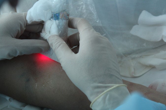 Điều trị giãn tĩnh mạch chân bằng laser có hiệu quả