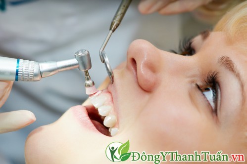 lấy cao răng là cách chữa viêm lợi hiệu quả nhất