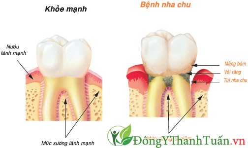 nguyên nhân chảy máu chân răng thường xuyên 2