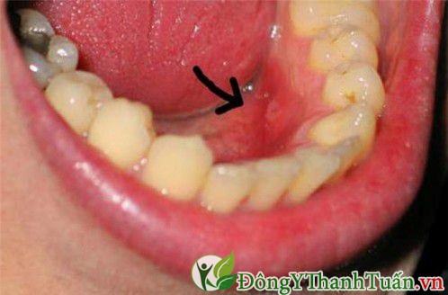 Nhiễm trùng vùng miệng là nguyên nhân gây đau răng