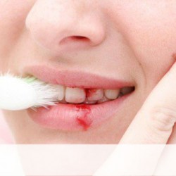 5 dấu hiệu nhận biết bệnh viêm nướu răng