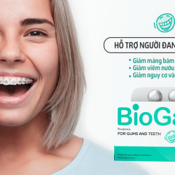 5 Điều lưu ý khi niềng răng quan trọng bạn cần biết – Chuyên gia nha khoa