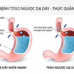 Bạn đã biết loại thuốc đông y điều trị bệnh trào ngược dạ dày nào hiệu quả chưa?
