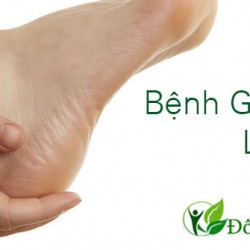 Bệnh gai gót chân là gì và biện pháp phòng ngừa bệnh