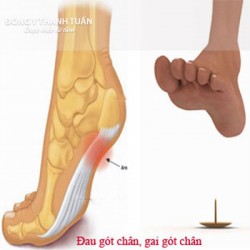Bệnh gai gót chân và cách điều trị