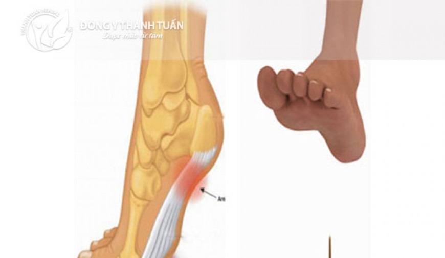 Bệnh gai gót chân và cách điều trị