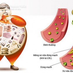 Bệnh mỡ trong máu – Những điều cần biết!