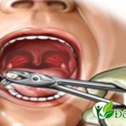 Bị sâu răng có nhất định phải nhổ?