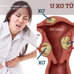 Bị u xơ tử cung nên và không nên ăn gì?