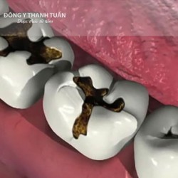 Cách chữa hôi miệng khi bị sâu răng
