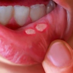 Thông tin Cách chữa nhiệt miệng đơn giản