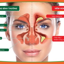 Thông tin Cách chữa viêm mũi, viêm xoang nào hiệu quả