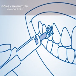 Cách Sử Dụng Bàn Chải Kẻ Răng Siêu Sạch Okamura Dental