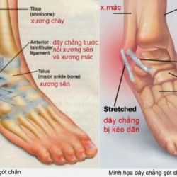 Đau gót chân là biểu hiện của bệnh gì? Có nguy hiểm không?