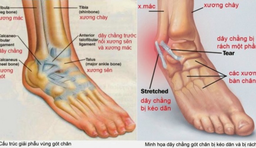 Đau gót chân là biểu hiện của bệnh gì? Có nguy hiểm không?