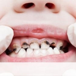Đau nhức răng phải làm sao điều trị?