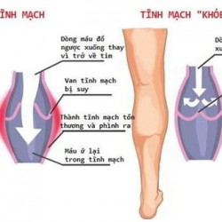 Địa chỉ tư vấn và bán thuốc điều trị suy giãn tĩnh mạch chân tại TPHCM