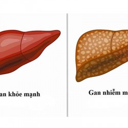 Gan nhiễm mỡ nên ăn gì để cải thiện sức khỏe lá gan?