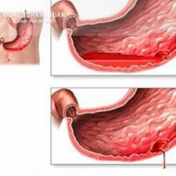 Một số dấu hiệu nhận biết đau dạ dày