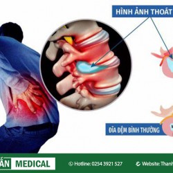 Người bị thoát vị đĩa đệm nên dùng ghế Massage KLC thế nào cho đúng cách?