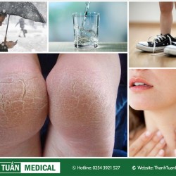 Nguyên nhân & biện pháp khắc phục gót chân bạn bị nứt nẻ