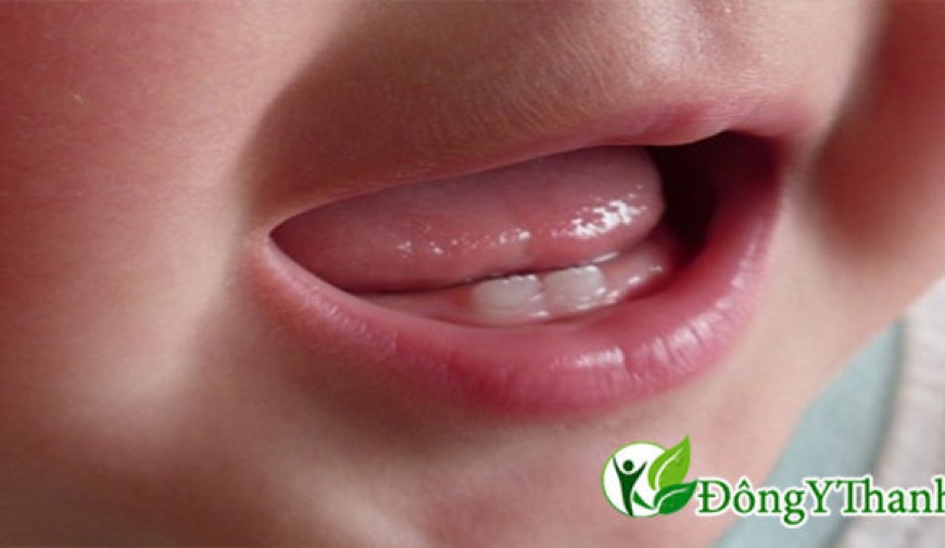 Nguyên nhân và cách điều trị trẻ bị viêm chân răng