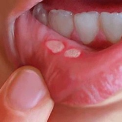 Nhiệt miệng có lây không?