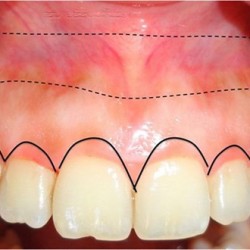 Sau bọc răng sứ bị viêm lợi, phải làm ngay điều này