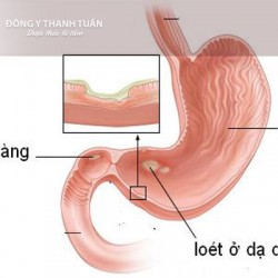 Tại sao bị trào ngược dạ dày thực quản