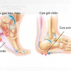 Tìm hiểu đau dưới gót chân là bệnh gì ?