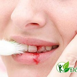 Vì sao hay bị chảy máu chân răng?