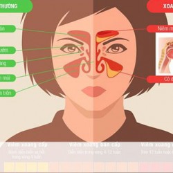 Viêm đa xoang mạn tính là gì?